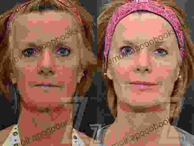 Before And After Photos Demonstrating The Effects Of Injectable Fillers On Different Facial Areas Illustrated Manual Of Injectable Fillers: A Technical Guide To The Volumetric Approach To Whole Body Rejuvenation (Series In Cosmetic And Laser Therapy)