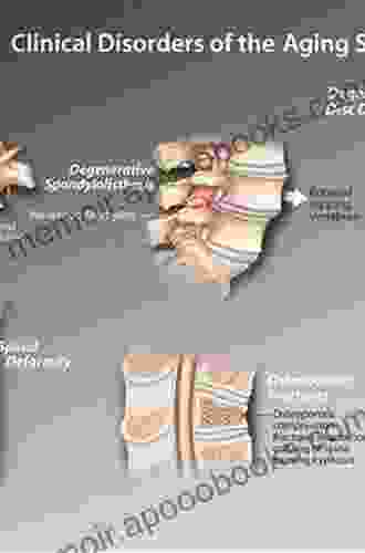 Advanced Concepts In Lumbar Degenerative Disk Disease