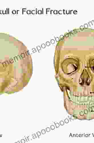 Fractures Of The Facial Skeleton