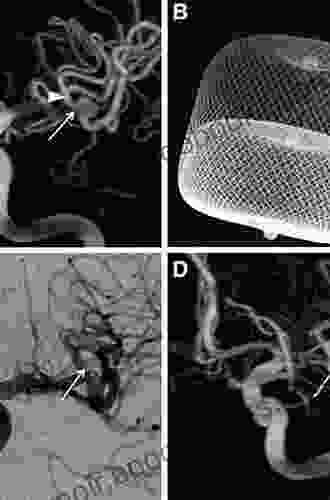 Surgical Neuroangiography: 4 Endovascular Treatment of Cerebral Lesions